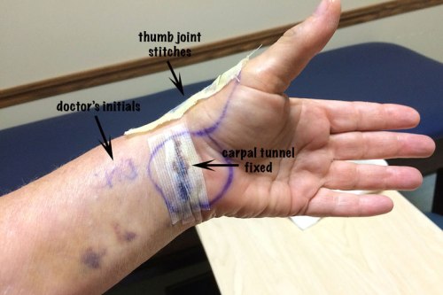 This is what my left hand looked like in the doctor’s office.